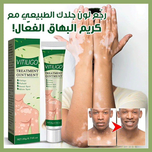 Eelhoe Vitiligo Cream - كريم إيلهو لعلاج البهاق