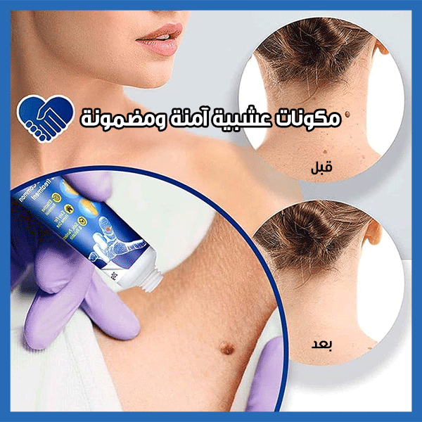 Wart Remover Ointment - مرهم لإزالة الثآليل