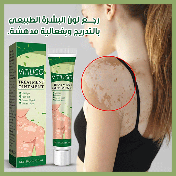Eelhoe Vitiligo Cream - كريم إيلهو لعلاج البهاق